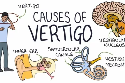 Brain Causes of Vertigo